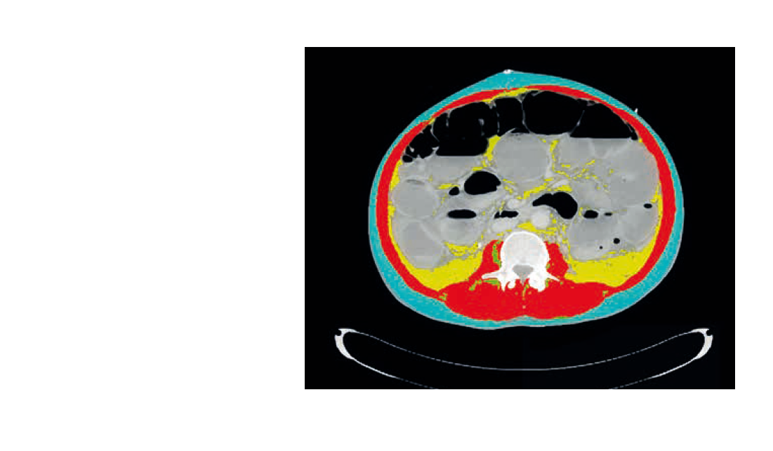 Afbeelding Spiermassa meten: CT-scan of antropometrie