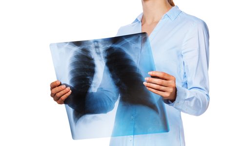 Afbeelding Vrouw met CF en longtransplantatie